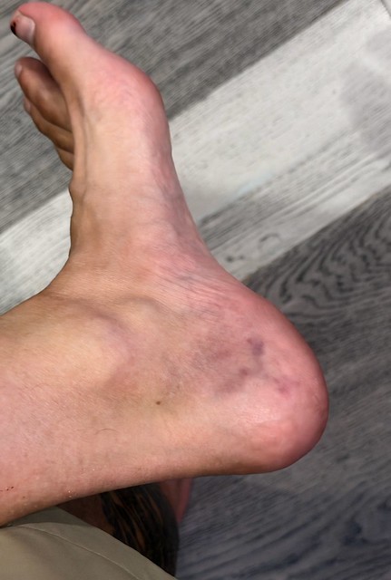 Can you tell where I got drilled by a golf ball?