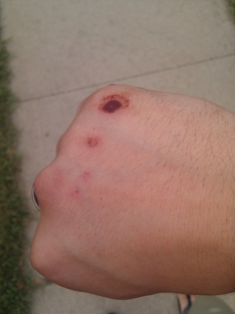 Scraped Knuckles