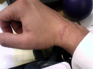 Pain - Oven Rack Burn