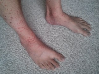 It seriously looks like I have chicken pox