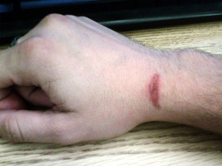 Pain - Oven Rack Burn