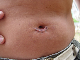 Where dad's appendix came out, haha.