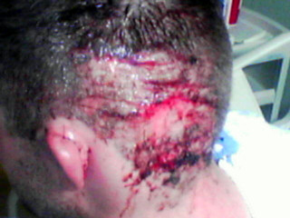 Pain - Jason's head 1 day after the wreck - you can see his ear stitched back together