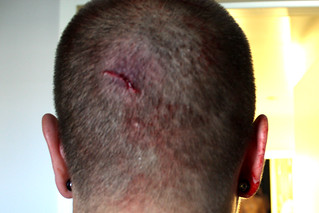 Pain - Cut in the back of my head
