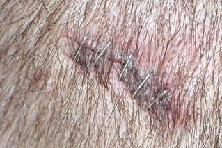 Pain - Staples in my head