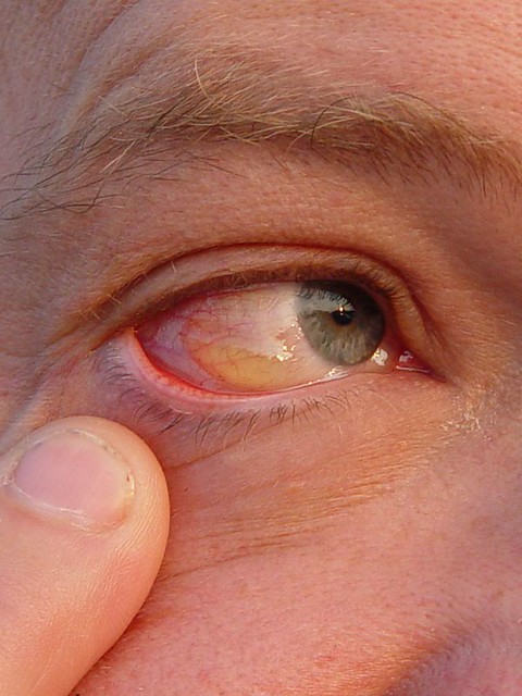 Dad got a huge blister on his eyeball